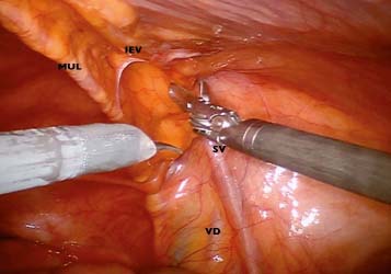 Crucial anatomy and technical cues for laparoscopic transabdominal