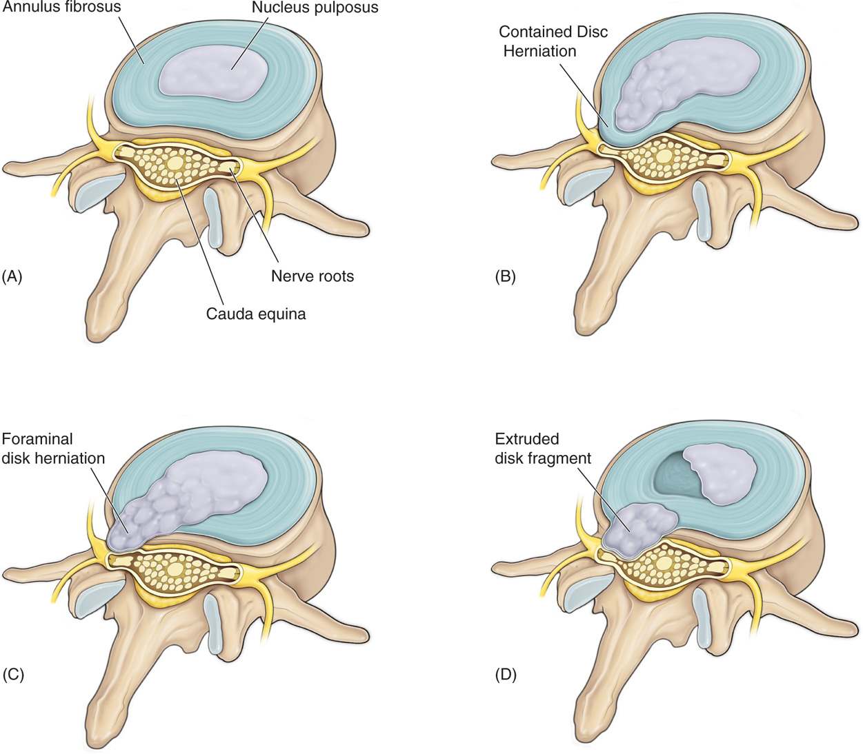 Lumbar Disc Herniation Symptoms