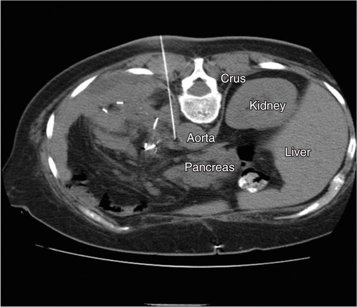 Celiac Plexus Block Using CT Guidance | Anesthesia Key