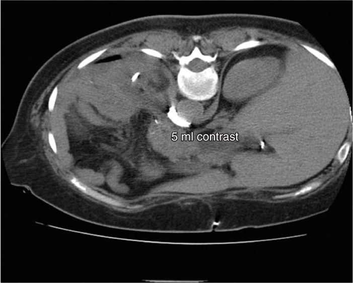 Celiac Plexus Block Using CT Guidance | Anesthesia Key