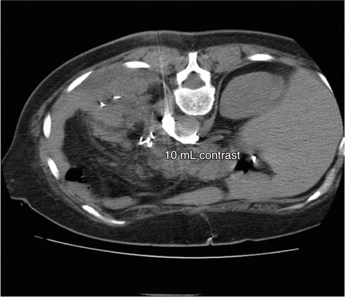 Celiac Plexus Block Using CT Guidance | Anesthesia Key