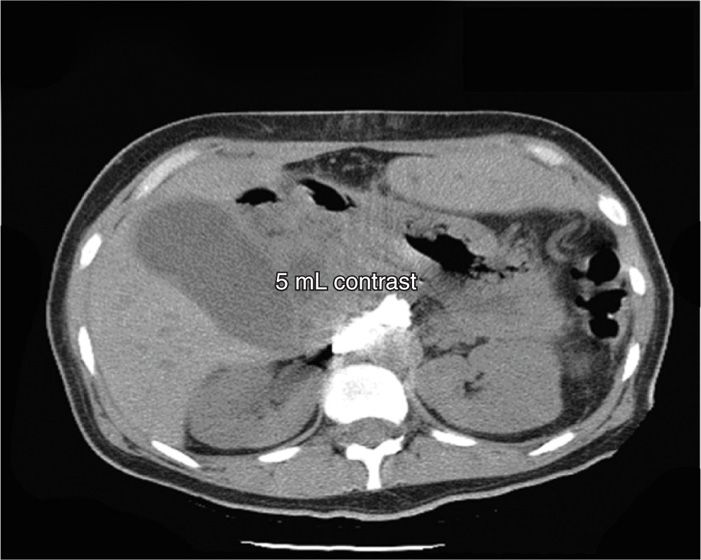 Celiac Plexus Block Using CT Guidance | Anesthesia Key