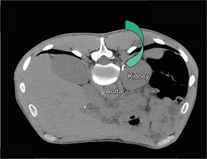 Celiac Plexus Block Using CT Guidance | Anesthesia Key