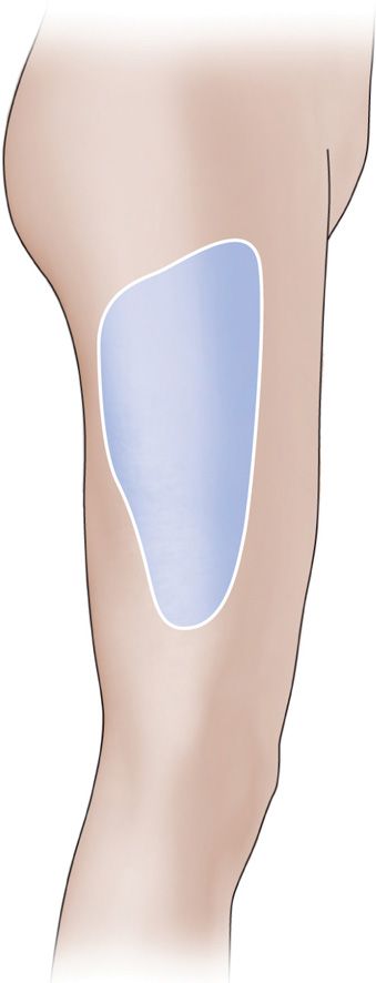 Lateral Femoral Cutaneous Nerve Block from the PNBschool