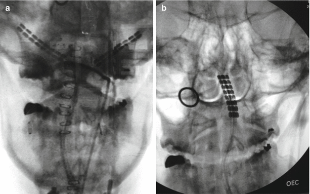 migration of dorsal column spinal cord stimulator