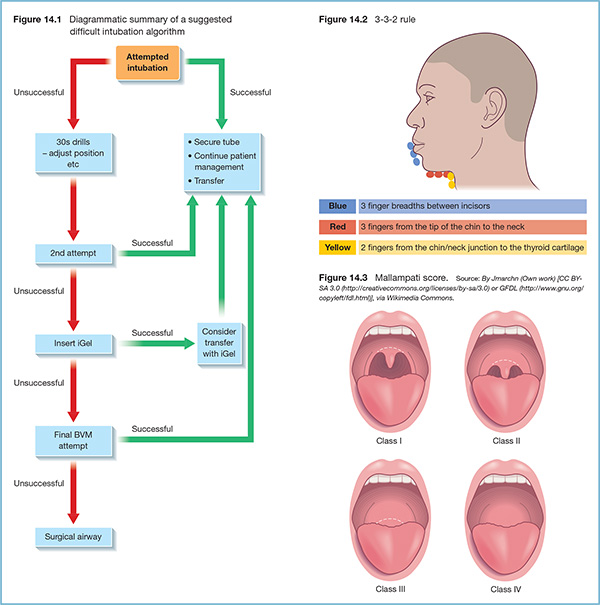 The difficult airway | Anesthesia Key