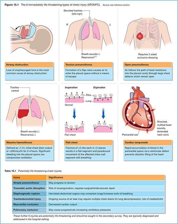 Diagrams show 6 types of immediately life-threatening chest injury with markings for airway obstruction, tension pneumothorax, open pneumothorax, massive haemothorax, et cetera.