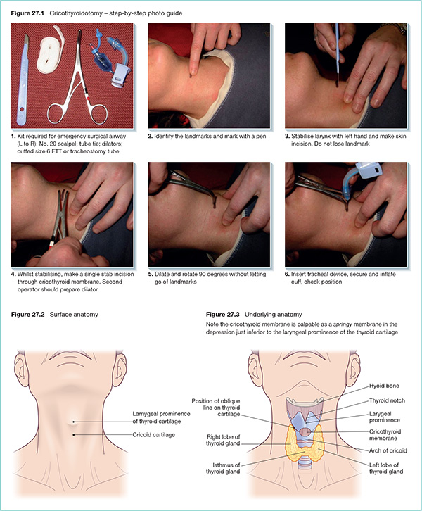 Photographs show step-by-step photo guide of cricothyroidotomy with markings for identify landmarks and mark with pen, insert tracheal device, secure and inflate cuff, check position, et cetera.