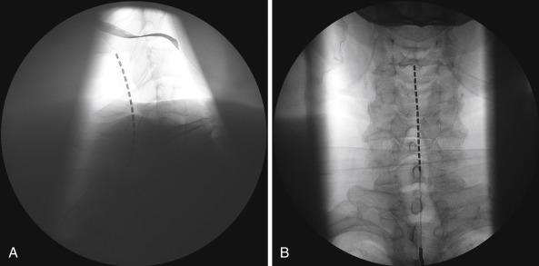 Spinal Cord And Peripheral Nerve Stimulation | Anesthesia Key