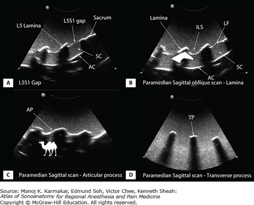 Ultrasound Imaging Of The Spine: Basic Considerations | Anesthesia Key