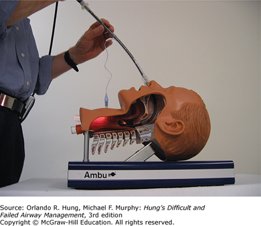 Flexible Bronchoscopic Intubation | Anesthesia Key