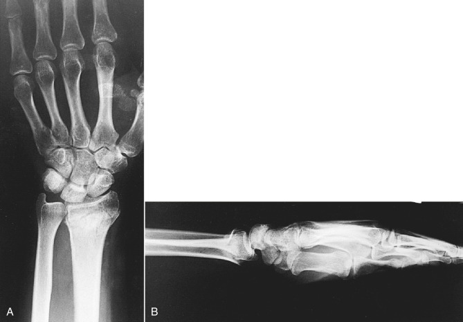 General Principles Of Fracture Care | Anesthesia Key