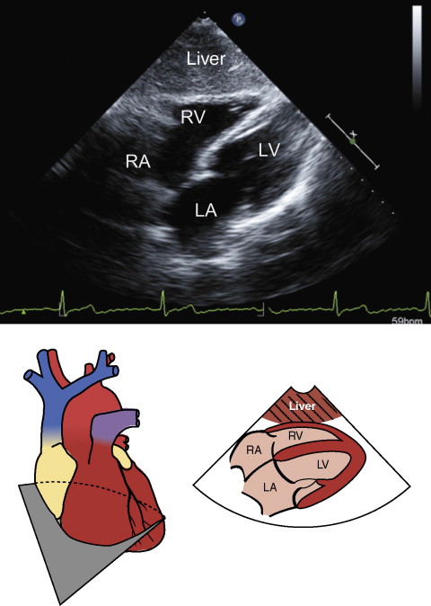 Transthoracic Echocardiography Standard Views | Anesthesia Key