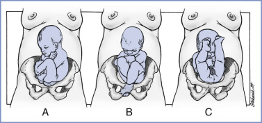 Abnormal Presentation And Multiple Gestation | Anesthesia Key