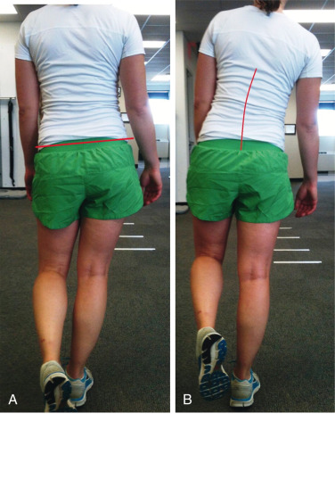 Trochanteric Bursitis | Anesthesia Key