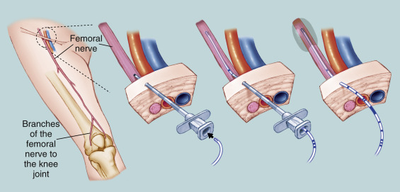 Continuous Peripheral Nerve Blocks | Anesthesia Key