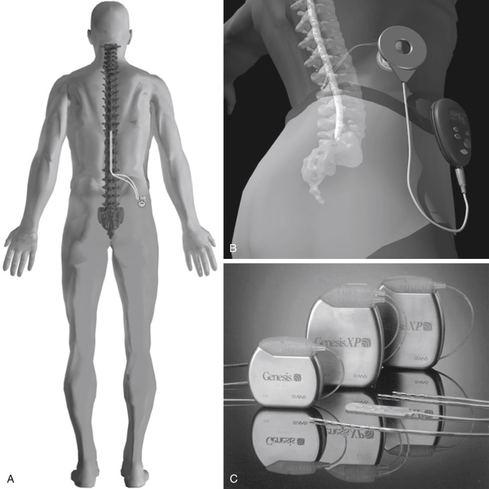 Spinal Cord Stimulation | Anesthesia Key