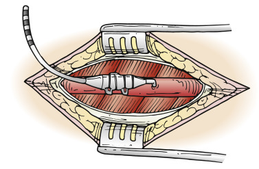 Spinal Cord Stimulation | Anesthesia Key