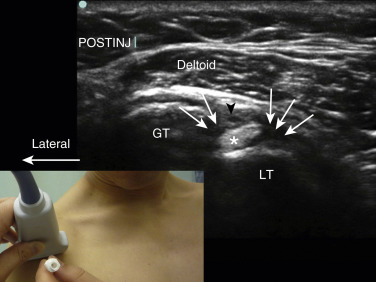 Ultrasound-Guided Musculoskeletal Injections—Shoulder, Hip, And Knee ...