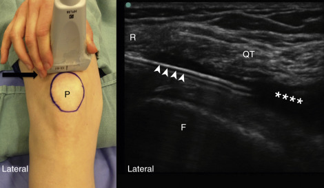 Ultrasound-Guided Musculoskeletal Injections—Shoulder, Hip, And Knee ...