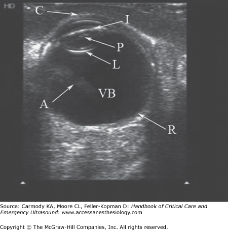 Ocular Ultrasound | Anesthesia Key