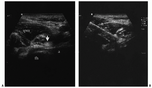 Ultrasound-Guided Injection Technique For Iliopsoas Bursitis Pain ...