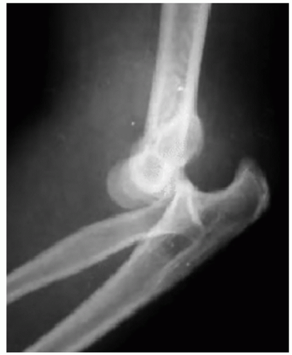 Ultrasound Guided Brachial Plexus Block Retroclavicular Approach