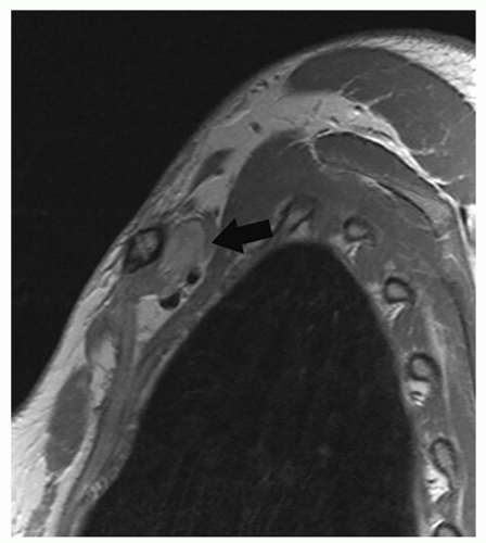 Ultrasound Guided Brachial Plexus Block Retroclavicular Approach