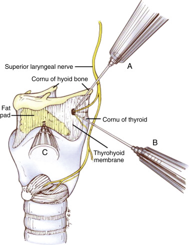 Airway Management In The Adult | Anesthesia Key