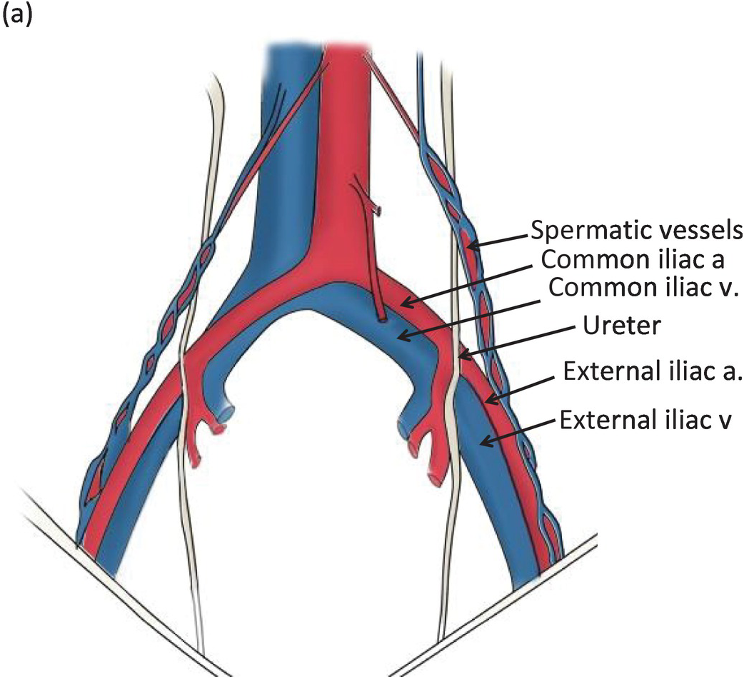 Chapter 32 – Iliac Vessel Injuries | Anesthesia Key