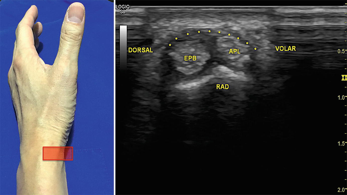 On Wrist And Hand | Anesthesia Key