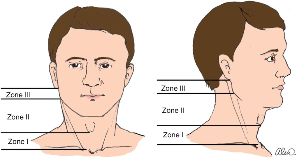 Chapter 12 – Neck Trauma | Anesthesia Key