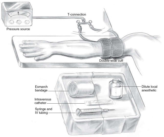 Intravenous Regional Block | Anesthesia Key