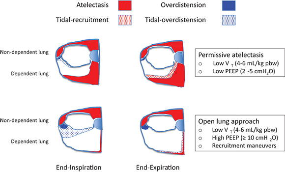 Management Of One-Lung Ventilation: Protective Lung Ventilation ...