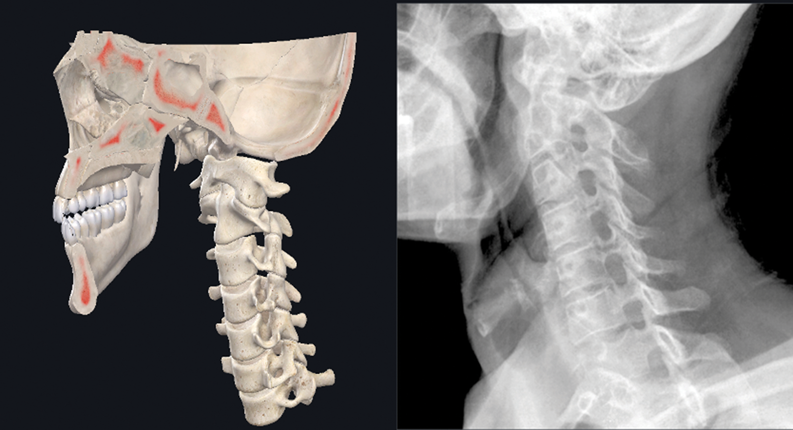 Complications Of Cervical And Thoracic Transforaminal Epidural Block ...