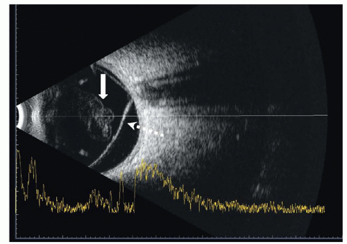 Vitreous Detachment, Retinal Tear, And Retinal Detachment | Anesthesia Key