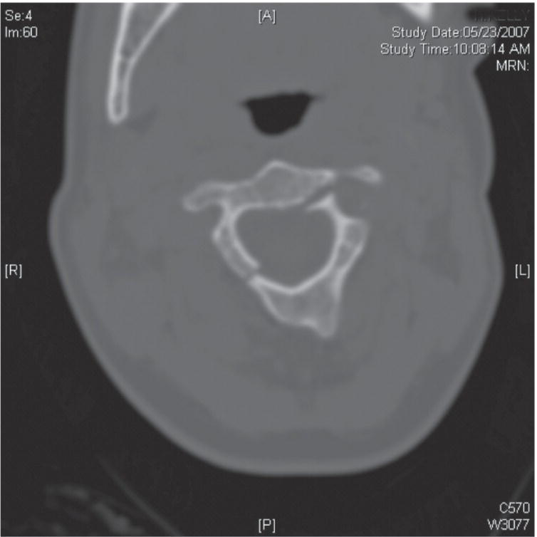 Schematic illustration of a second vertebral fracture is demonstrated on a cervical spine CT.