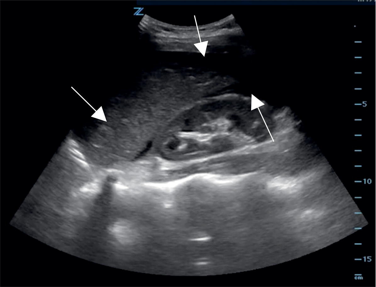 Schematic illustration of a focused assessment by sonography in trauma (FAST) reveals fluid in Morison's pouch and surrounding the caudal tip of the liver (arrows).