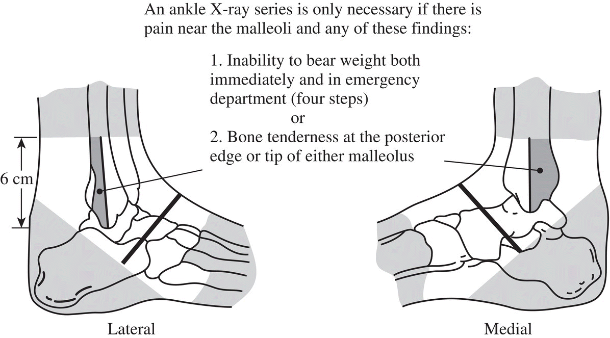 Schematic illustration of the Ottawa ankle and foot rules.