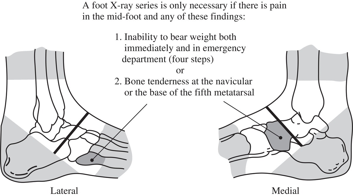 Schematic illustration of the Ottawa foot rules.