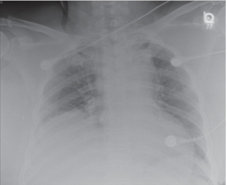 Chest Trauma Anesthesia Key