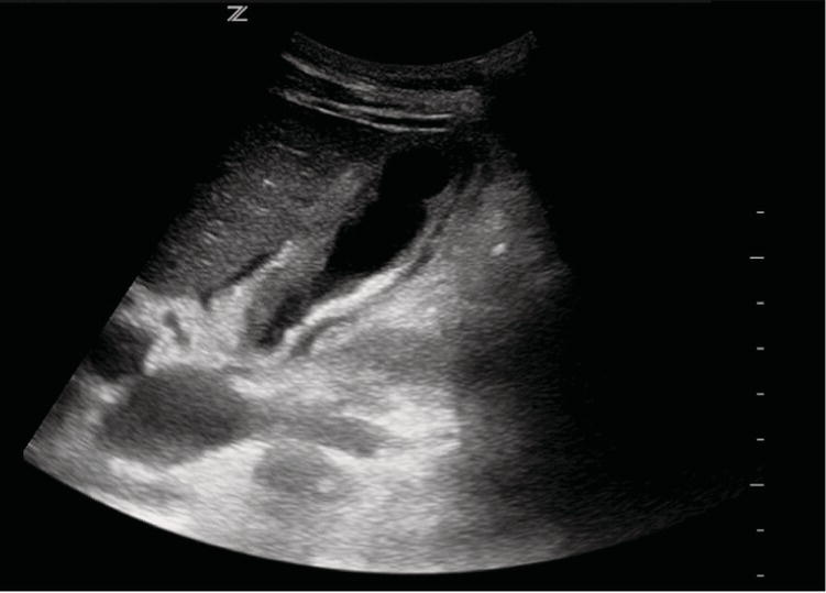 Photo depicts acute cholecystitis with a thickened gallbladder wall and pericholecystic fluid seen on ultrasound.