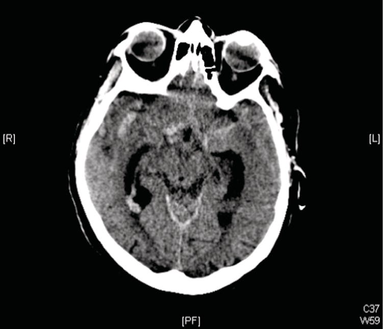 Nontraumatic Subarachnoid Hemorrhage Anesthesia Key