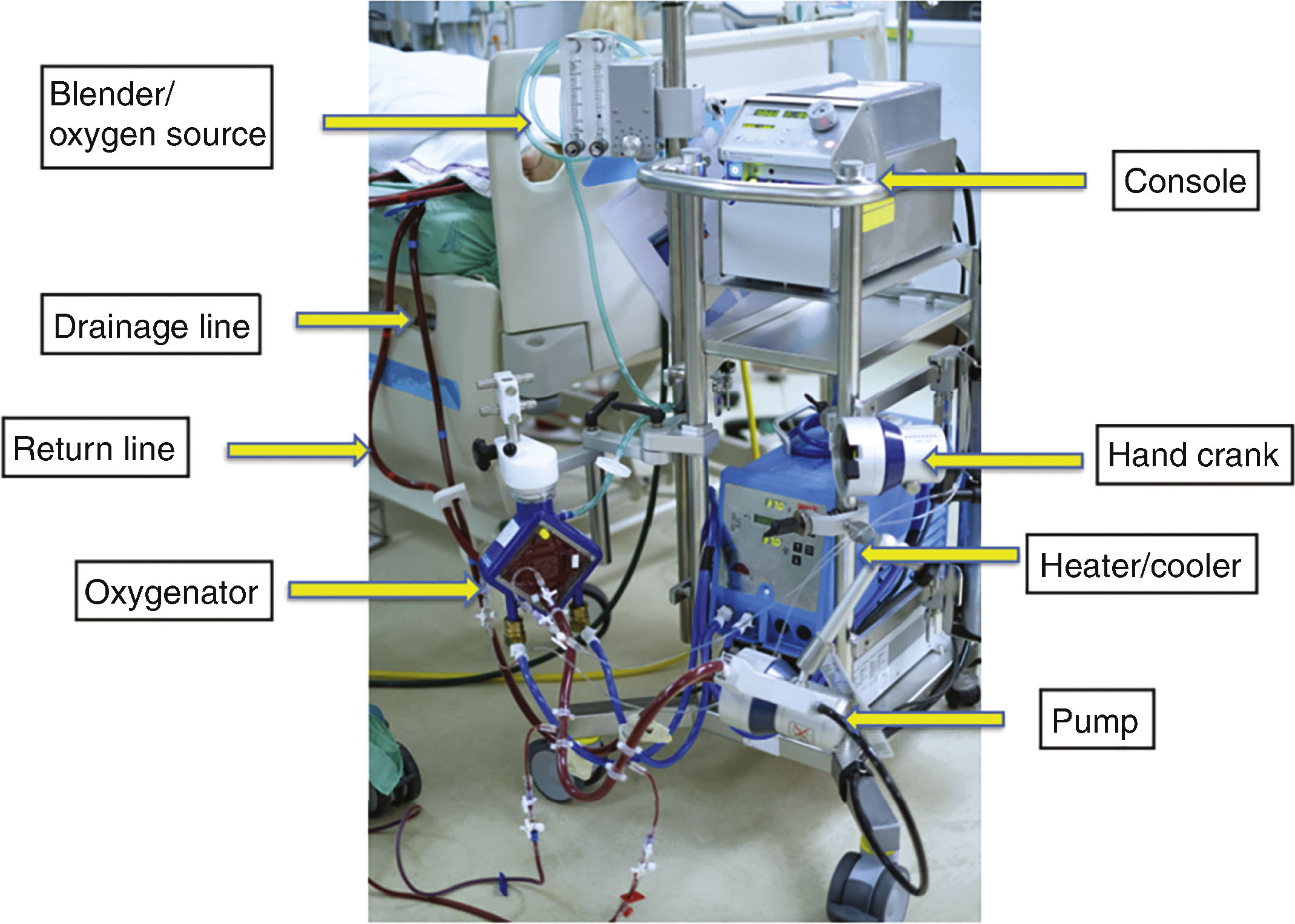 Introduction To ECMO Fundamentals | Anesthesia Key