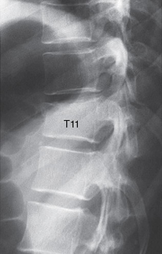 Vertebral Augmentation Using Expandable Intravertebral Implants ...