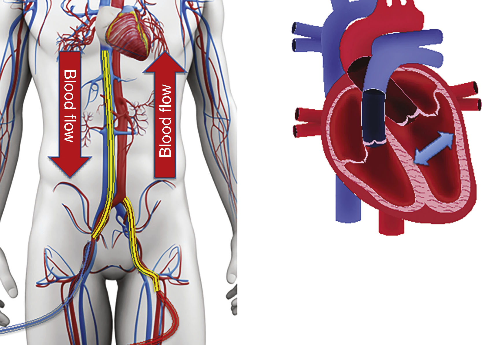 Veno-Arterial ECMO Physiology | Anesthesia Key