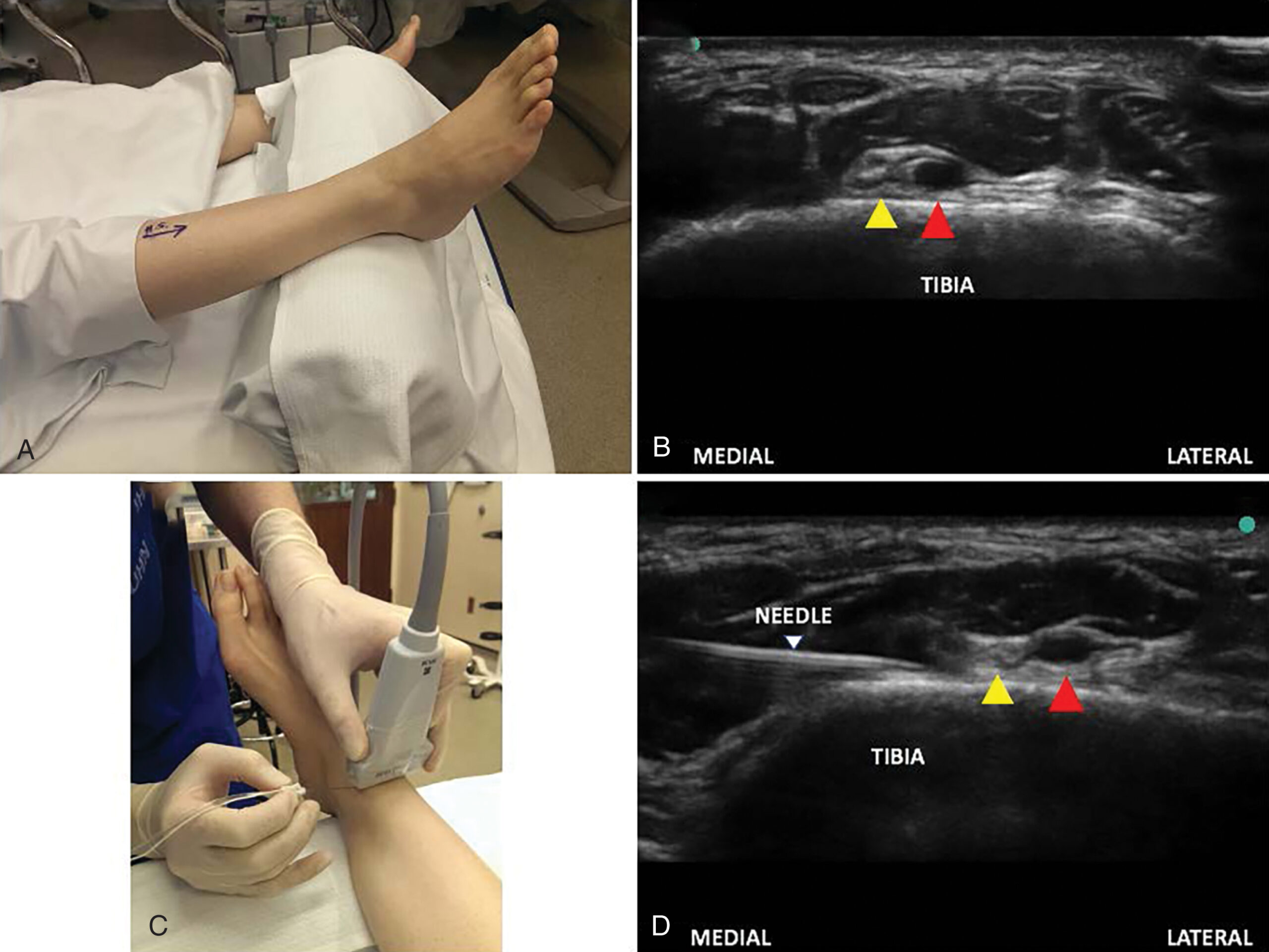 Radiofrequency Ablation And Pulsed Radiofrequency Of The Lower ...