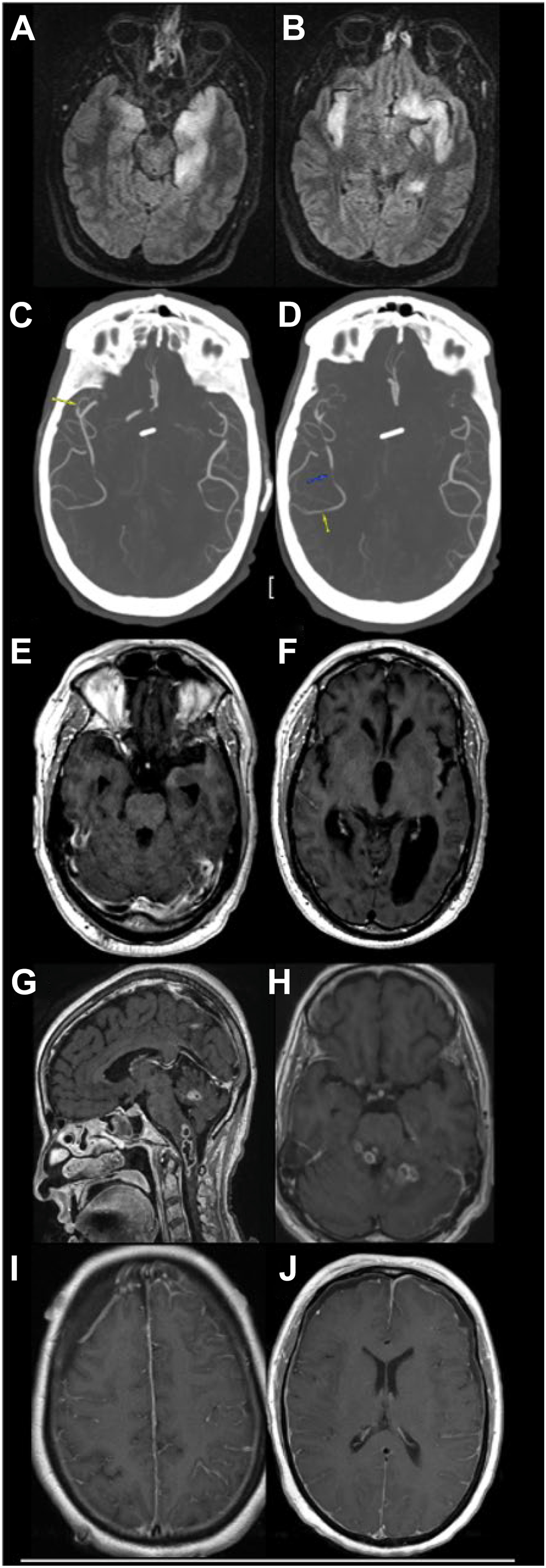 Ten panels show M R I and C T findings of brain infections, including H S V encephalitis, C M V meningoencephalitis, and fungal, bacterial, and Listeria meningitis.