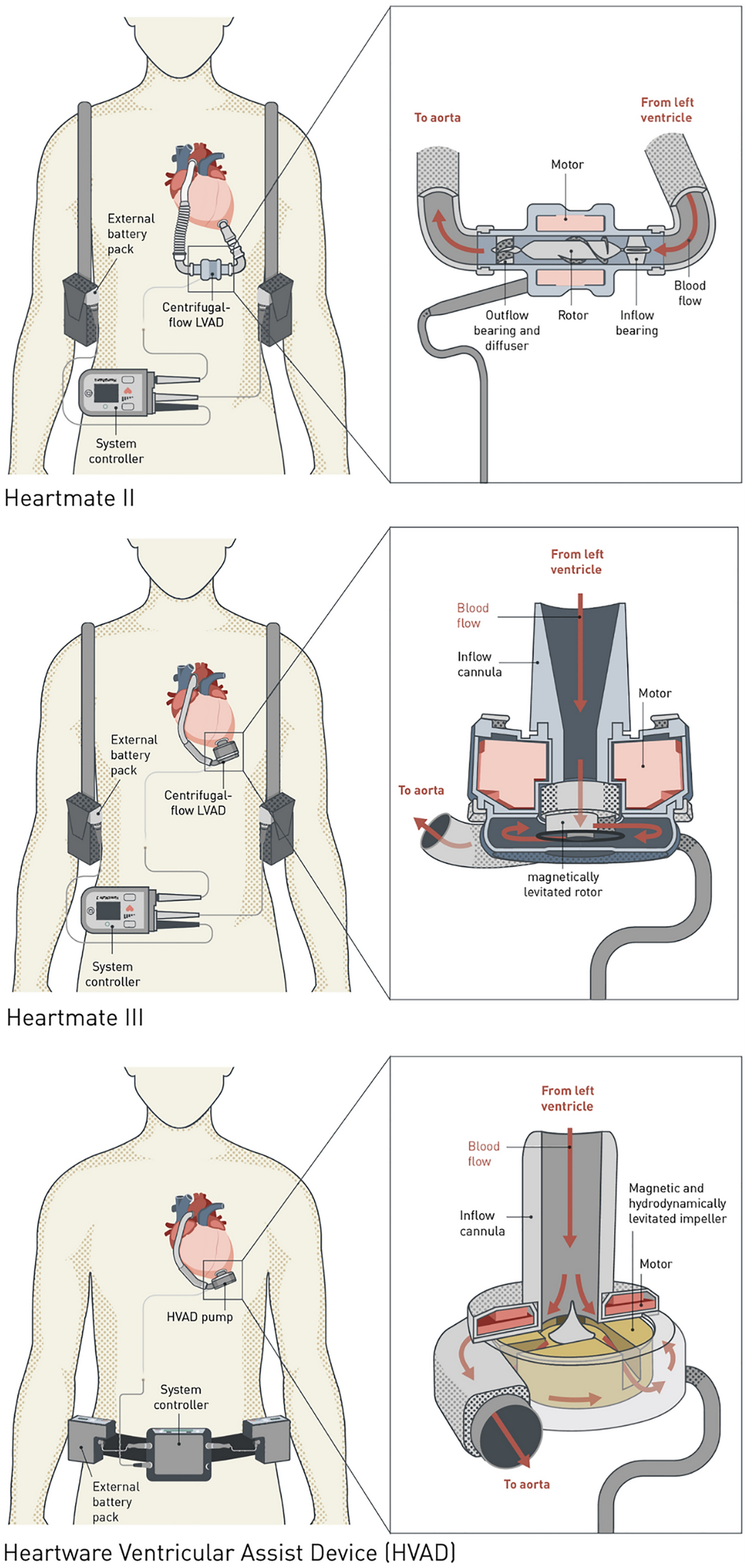 A medical diagram shows ventricular assist devices with external components, a blood pump, and flow direction for heart support.