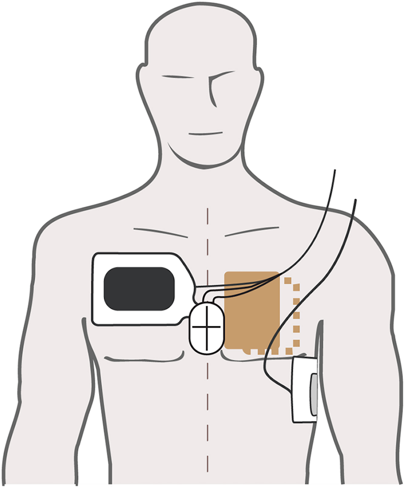 A medical illustration shows electrode pad placement on the chest for defibrillation, with one pad near the upper chest and one on the side.